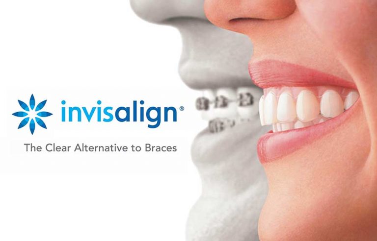 invisalign-go-quirke-dental-surgeons